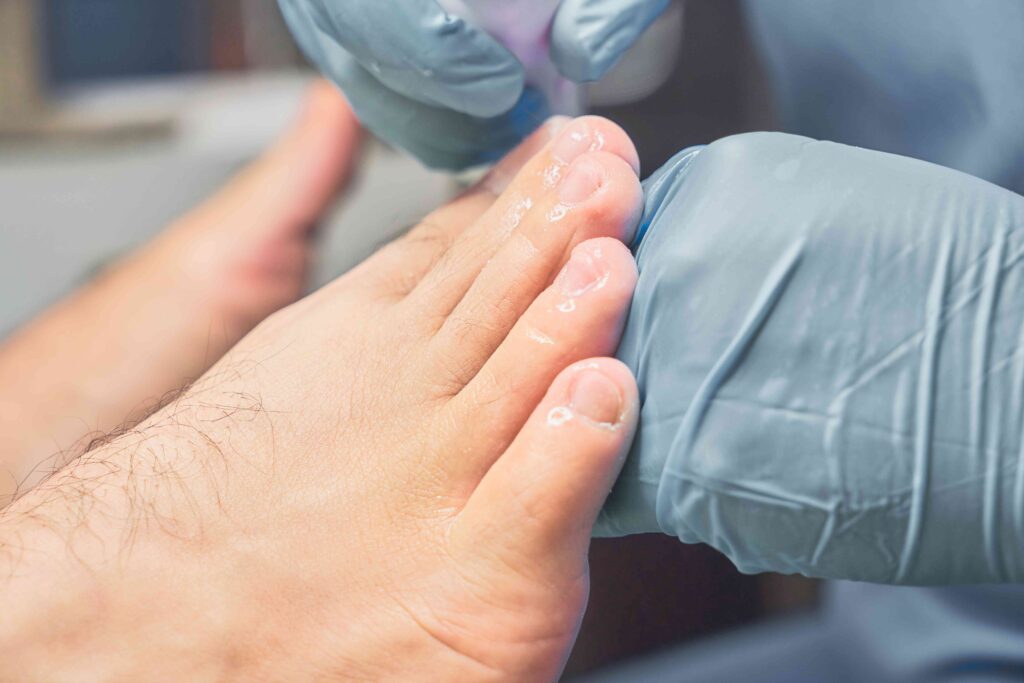 Onycholysis (Fingernail or Toenail Separation)