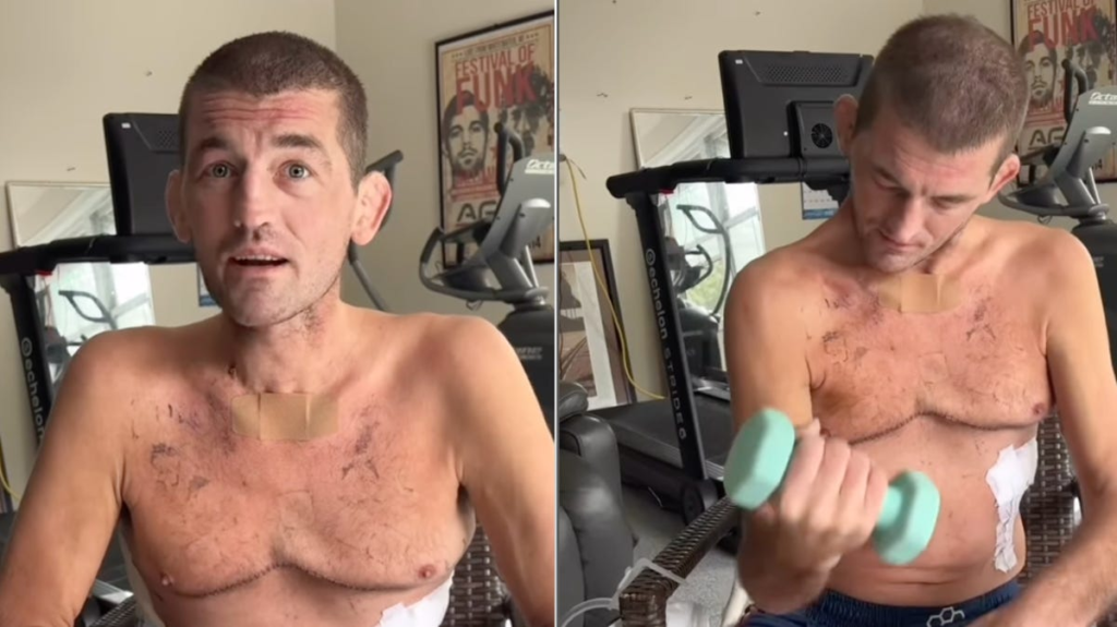 Askren shows post-lung transplant physique, vows to build back