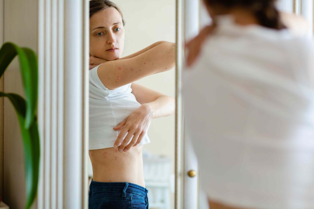 Guttate Psoriasis: Causes, Symptoms, and Treatment