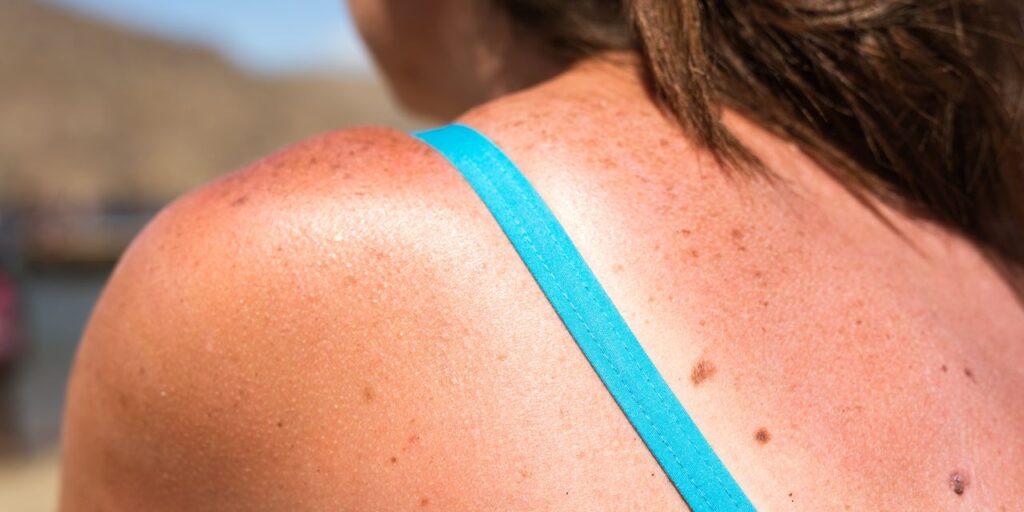Here’s How to Treat Sunburn Quickly, According to Dermatologists