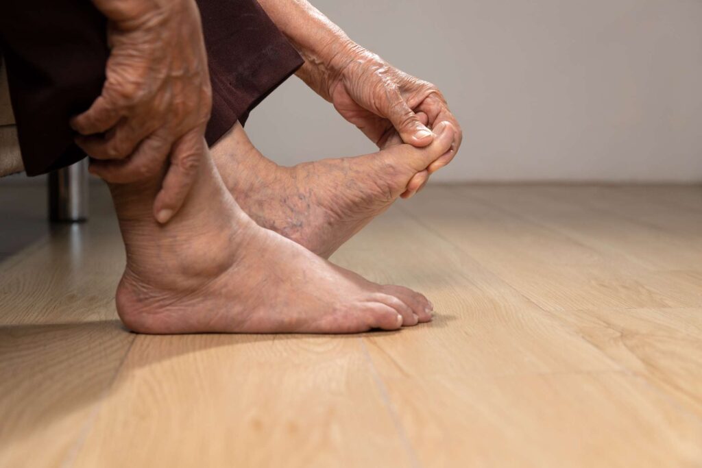 How Does Psoriatic Arthritis Affect Your Feet?