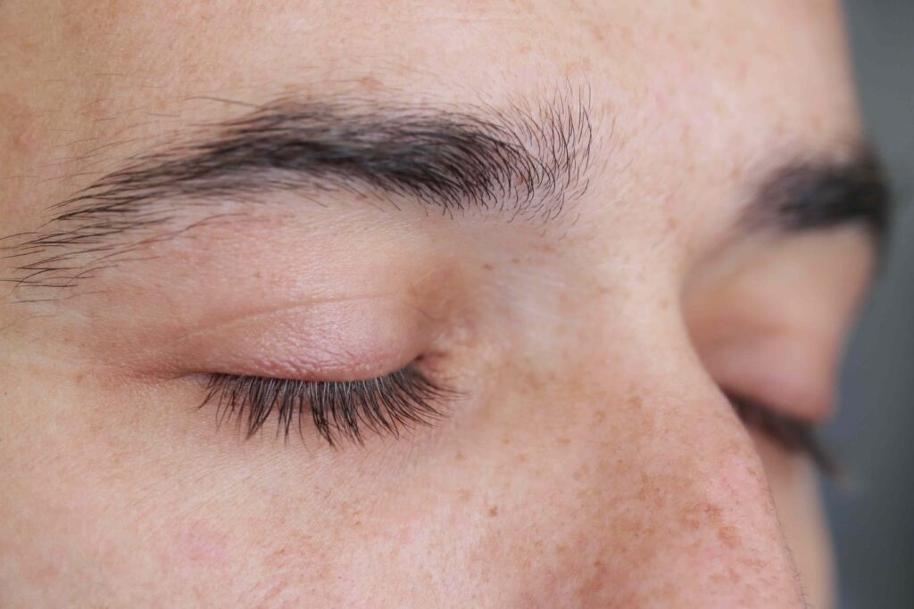 How To Know if You Have Psoriasis on Your Eyelid