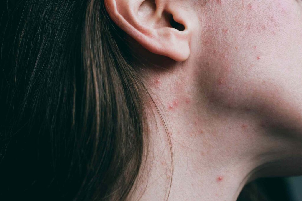 Neck Acne: Causes, Treatments, Prevention
