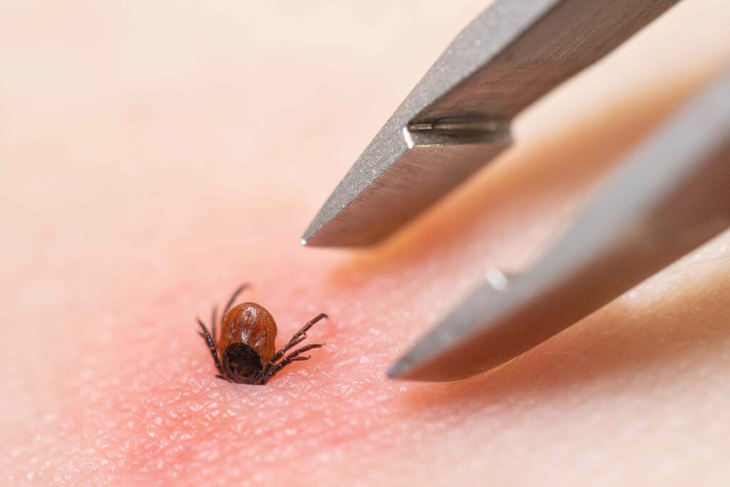 Symptoms, Risk Factors, Complications, Treatment