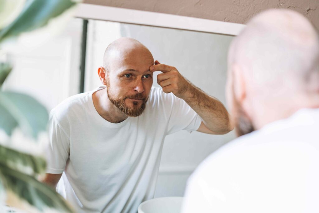 What To Know About Eyebrow Dandruff