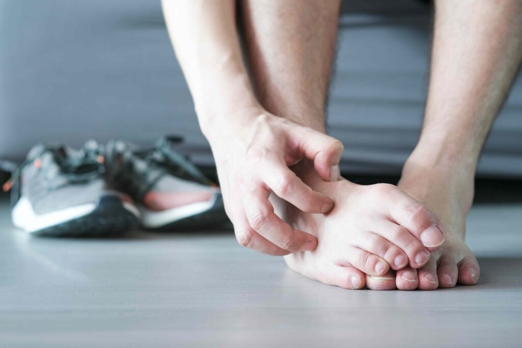 4 Early Signs of Athlete’s Foot You Shouldn’t Ignore
