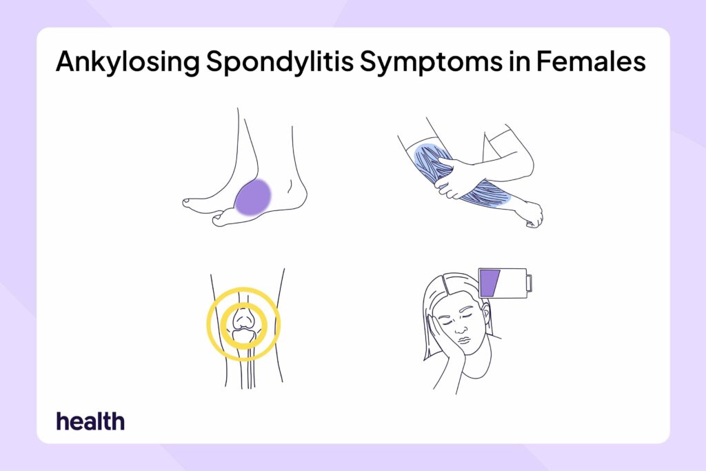 How Ankylosing Spondylitis Symptoms Can Affect Females