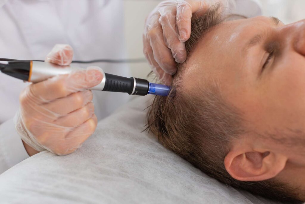 Can Microneedling Your Scalp Actually Help Regrow Your Hair?